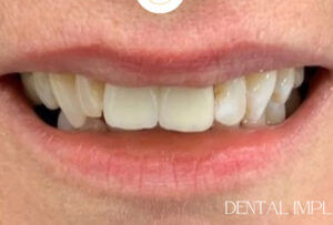 Dental Implants Berkshire - Case1b