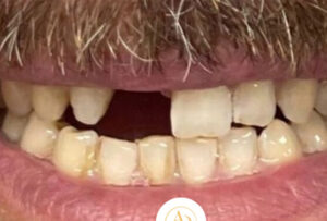 Teeth in a Day Berkshire