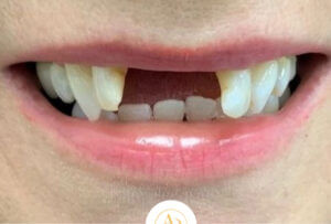 Tooth Replacement Berkshire