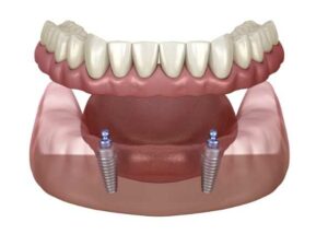 implant retained dentures ascot