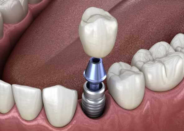 single dental implant